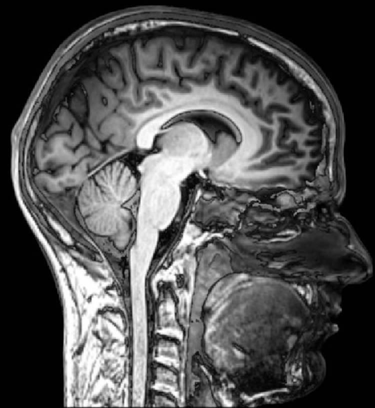 Normal MRI Brain Scan Image